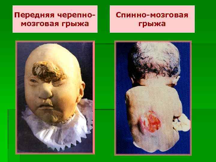 Передняя черепномозговая грыжа Спинно-мозговая грыжа 