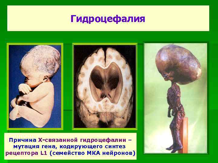 Гидроцефалия Причина Х-связанной гидроцефалии – мутация гена, кодирующего синтез рецептора L 1 (семейство МКА