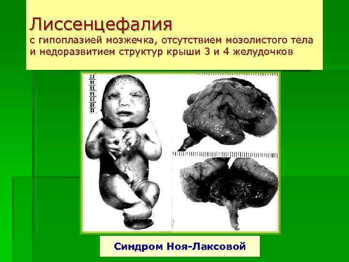 Лиссенцефалия с гипоплазией мозжечка, отсутствием мозолистого тела и недоразвитием структур крыши 3 и 4