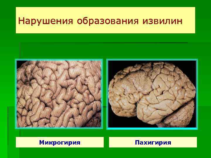 Нарушения образования извилин Микрогирия Пахигирия 