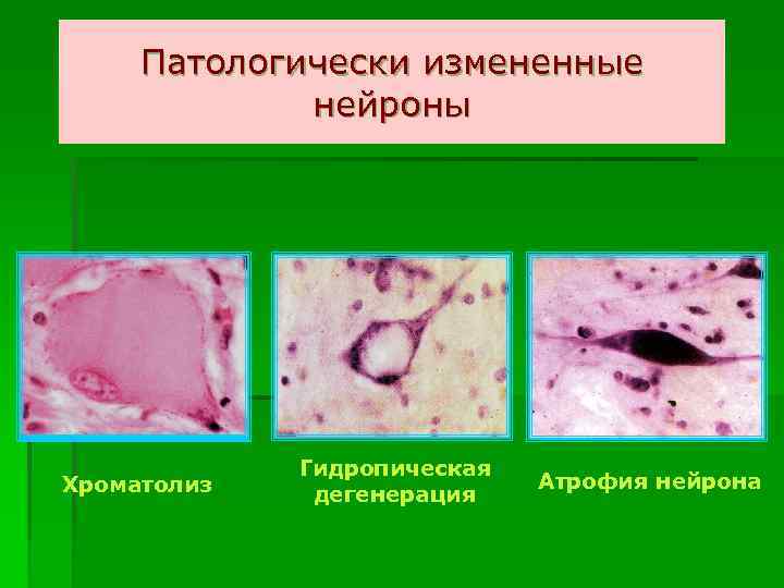 Патологически измененные нейроны Хроматолиз Гидропическая дегенерация Атрофия нейрона 