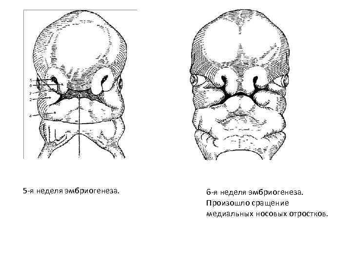 5 -я неделя эмбриогенеза. 6 -я неделя эмбриогенеза. Произошло сращение медиальных носовых отростков. 