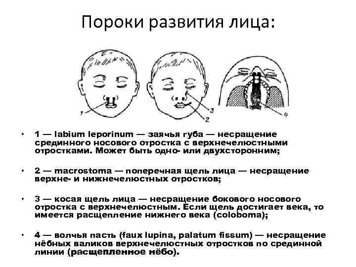 Пороки развития лица: • 1 — labium leporinum — заячья губа — несращение срединного