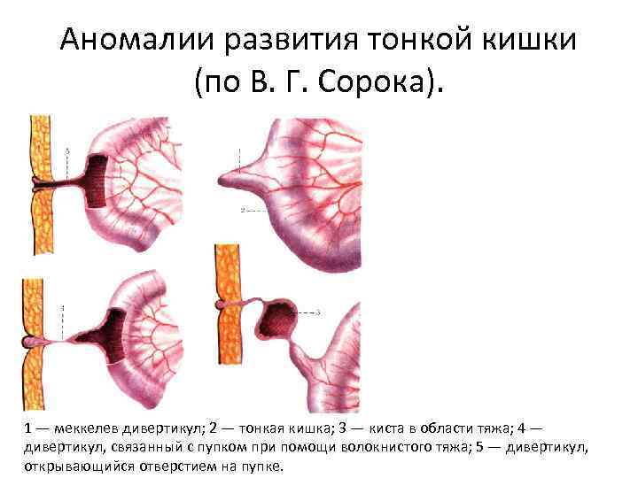 Аномалии развития тонкой кишки (по В. Г. Сорока). 1 — меккелев дивертикул; 2 —