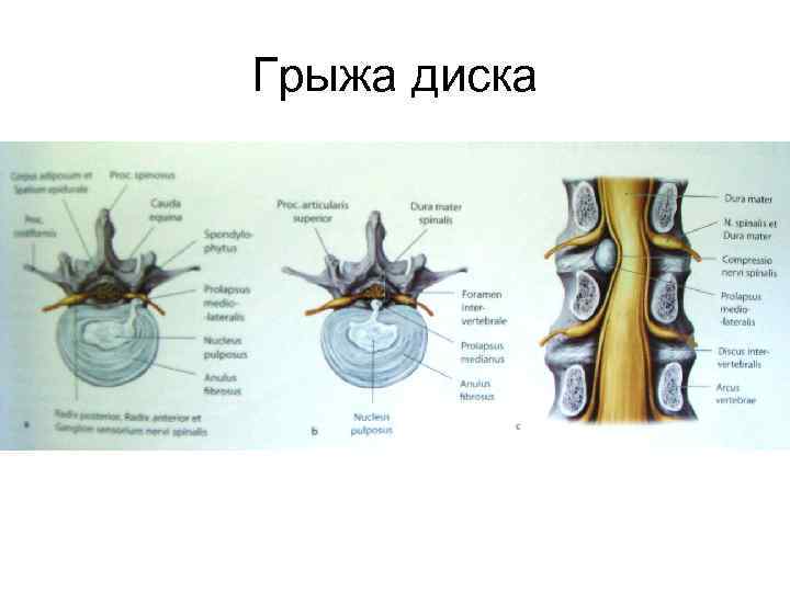 Грыжа диска 