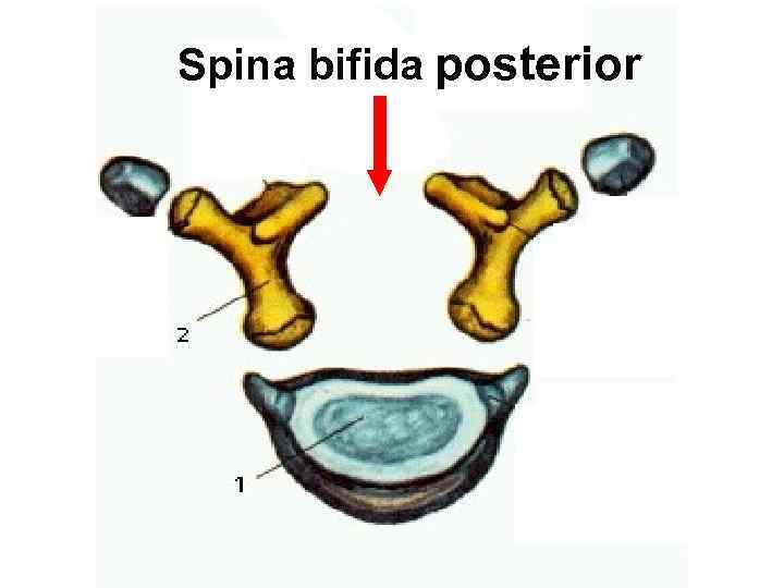 Spina bifida posterior 