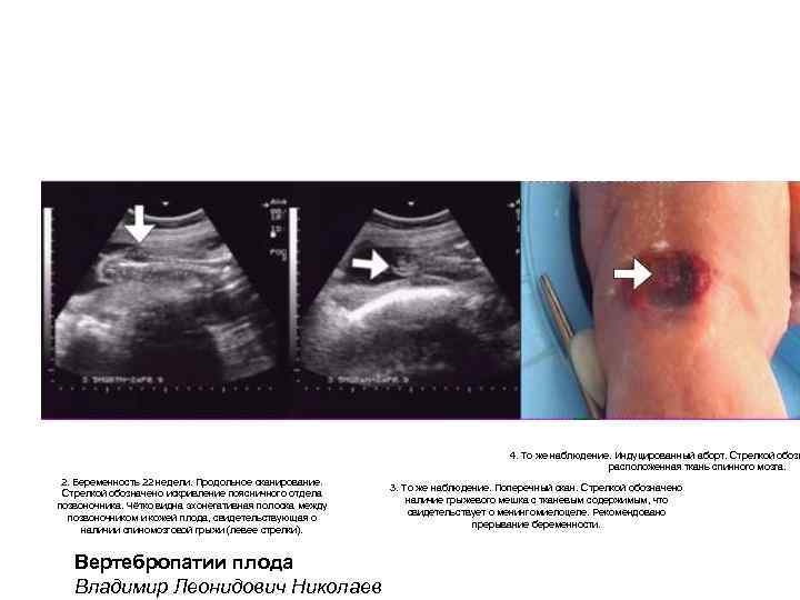 4. То же наблюдение. Индуцированный аборт. Стрелкой обозн расположенная ткань спинного мозга. 2. Беременность