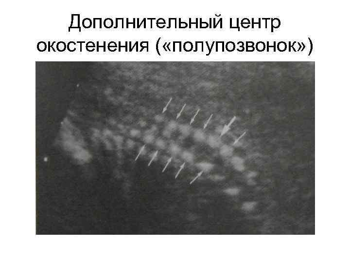 Дополнительный центр окостенения ( «полупозвонок» ) 