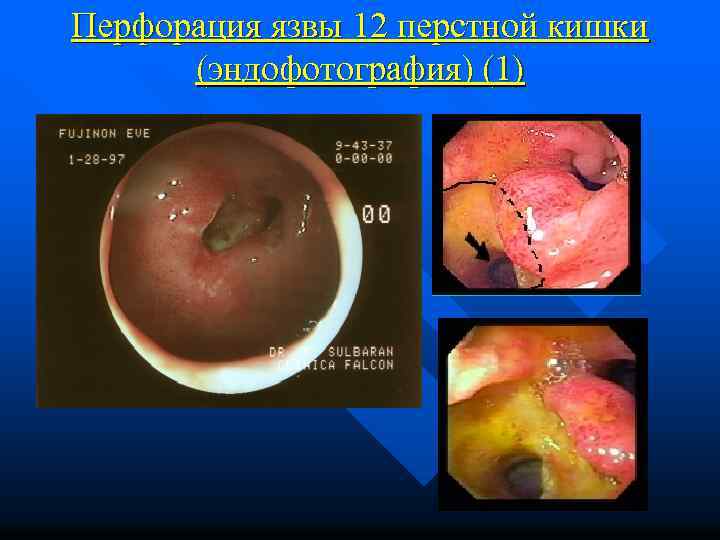 Перфорация язвы 12 перстной кишки (эндофотография) (1) 