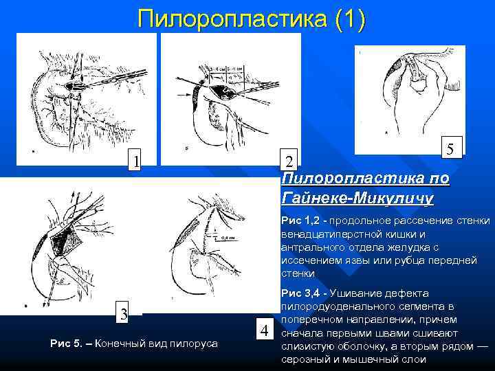 Пилоропластика (1) 5 1 2 Пилоропластика по Гайнеке-Микуличу Рис 1, 2 - продольное рассечение