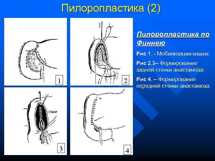 Пилоропластика (2) Пилоропластика по Финнею Рис 1. - Мобилизация кишки; Рис 2, 3– Формирование