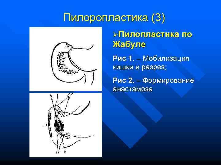 Пилоропластика (3) ØПилопластика по Жабуле Рис 1. – Мобилизация кишки и разрез; Рис 2.