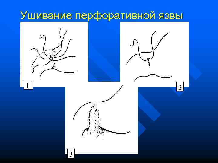 Ушивание перфоративной язвы 1 2 3 