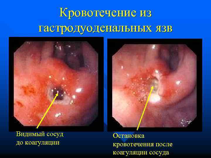 Кровотечение из гастродуоденальных язв Видимый сосуд до коагуляции Остановка кровотечения после коагуляции сосуда 