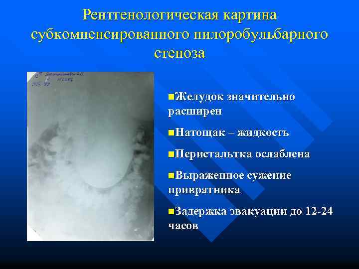 Рентгенологическая картина субкомпенсированного пилоробульбарного стеноза n. Желудок значительно расширен n. Натощак – жидкость n.