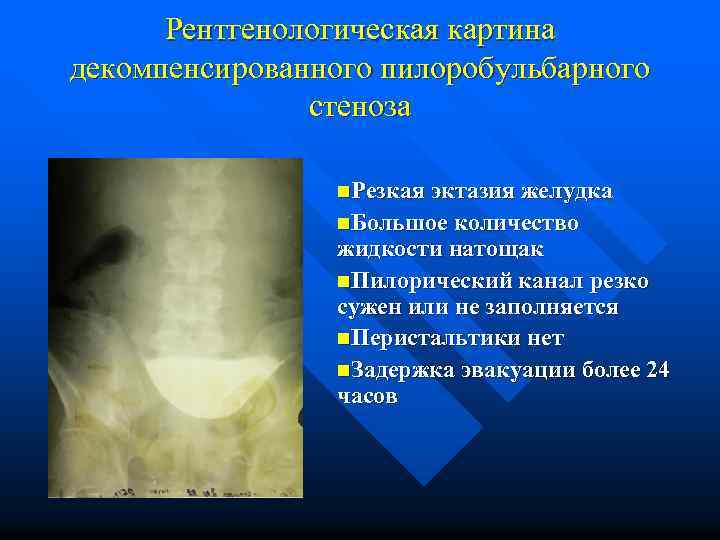 Рентгенологическая картина декомпенсированного пилоробульбарного стеноза n. Резкая эктазия желудка n. Большое количество жидкости натощак