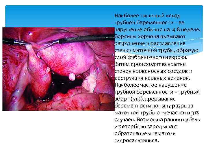 Наиболее типичный исход трубной беременности – ее нарушение обычно на 4 -8 неделе. Ворсины