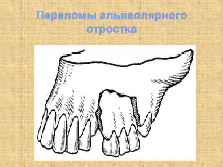 Переломы альвеолярного отростка 