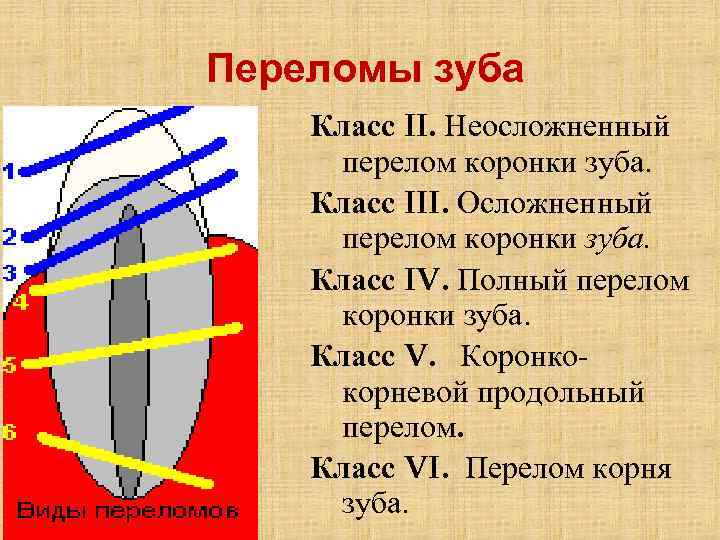 Переломы зуба Класс II. Неосложненный перелом коронки зуба. Класс III. Осложненный перелом коронки зуба.