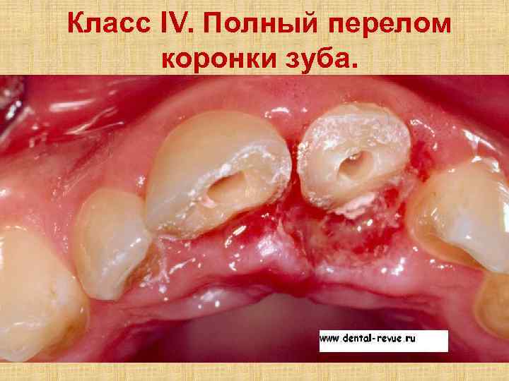 Класс IV. Полный перелом коронки зуба. 