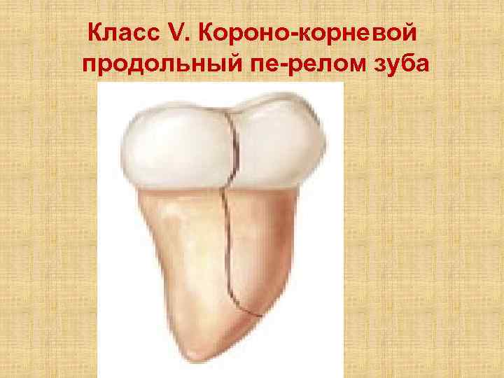 Класс V. Короно корневой продольный пе релом зуба 