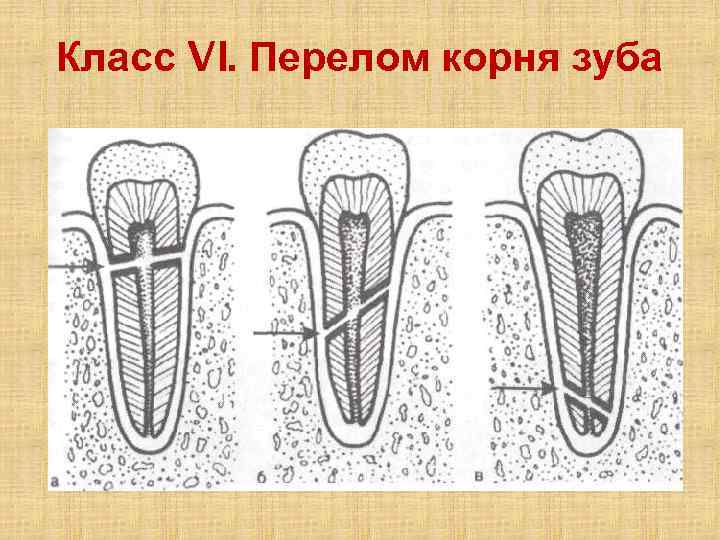 Признаки коронки зуба. Коронково корневой перелом. Переломы зубов классификация. Перелом корня зуба классификация.