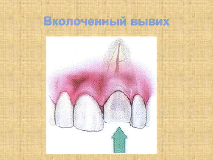 Вколоченный вывих 