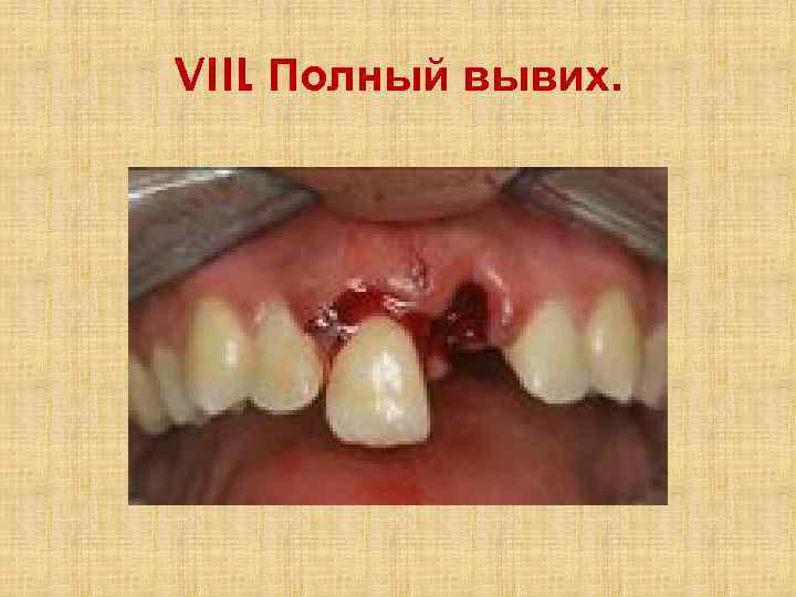 VIII. Полный вывих. 