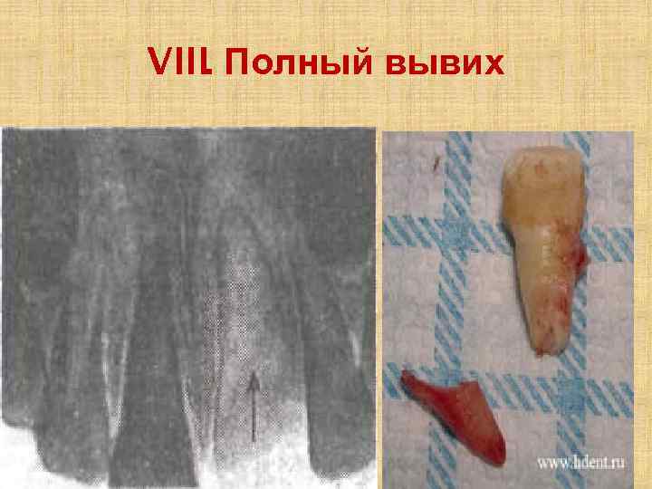 VIII. Полный вывих 