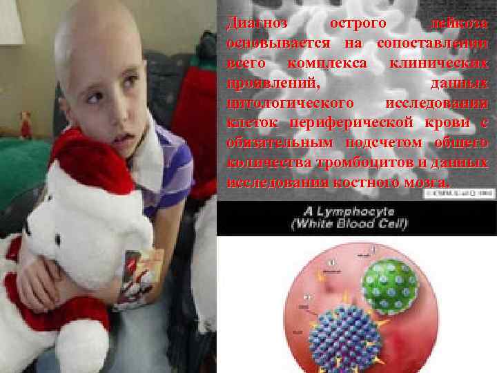 Диагноз острого лейкоза основывается на сопоставлении всего комплекса клинических проявлений, данных цитологического исследования клеток