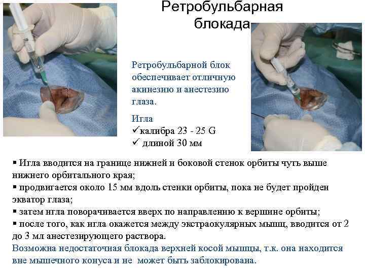 Ретробульбарная блокада Ретробульбарной блок обеспечивает отличную акинезию и анестезию глаза. Игла üкалибра 23 -