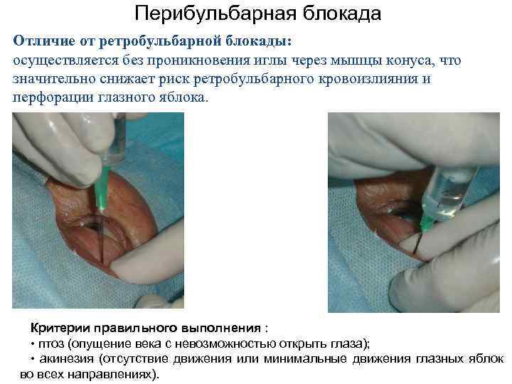 Перибульбарная блокада Отличие от ретробульбарной блокады: осуществляется без проникновения иглы через мышцы конуса, что