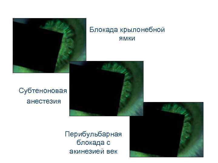 Блокада крылонебной ямки Cубтеноновая анестезия Перибульбарная блокада с акинезией век 