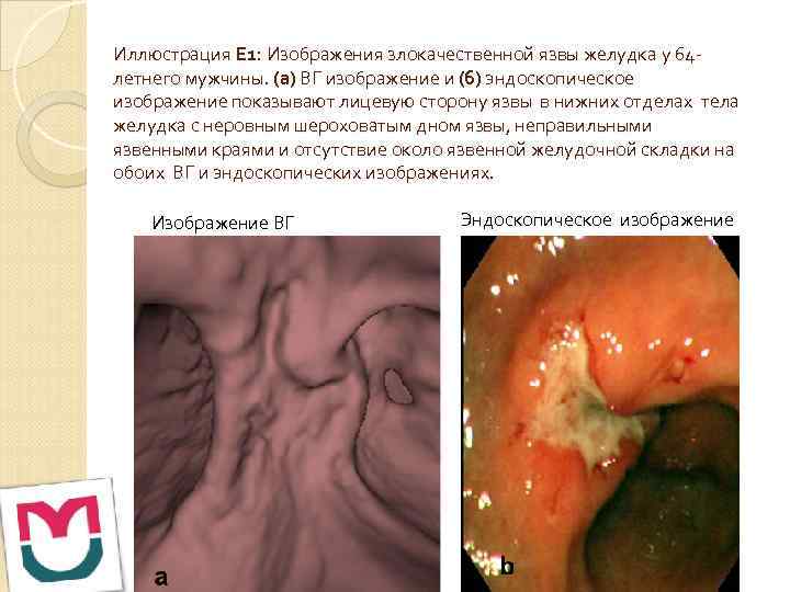 Иллюстрация Е 1: Изображения злокачественной язвы желудка у 64 летнего мужчины. (а) ВГ изображение