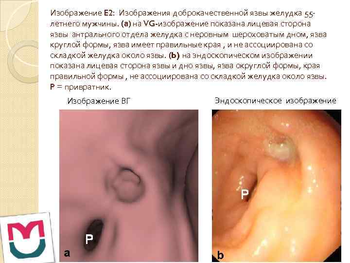 Изображение E 2: Изображения доброкачественной язвы желудка 55 летнего мужчины. (а) на VG-изображение показана