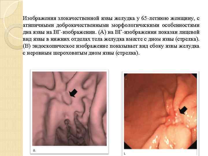 Изображения злокачественной язвы желудка у 65 -летнюю женщину, с атипичными доброкачественными морфологическими особенностями дна