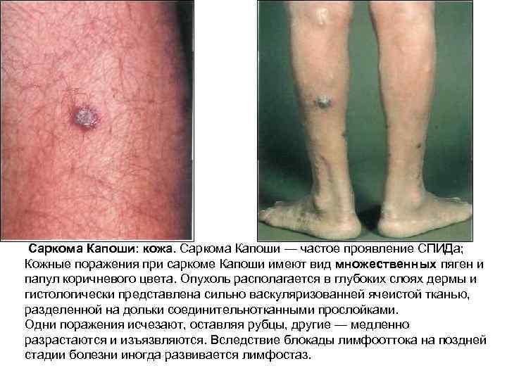  Саркома Капоши: кожа. Саркома Капоши — частое проявление СПИДа; Кожные поражения при саркоме