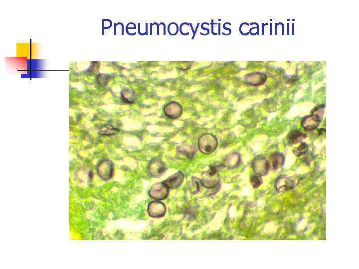 Pneumocystis carinii 