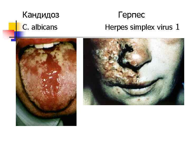 Кандидоз C. albicans Герпес Herpes simplex virus 1 