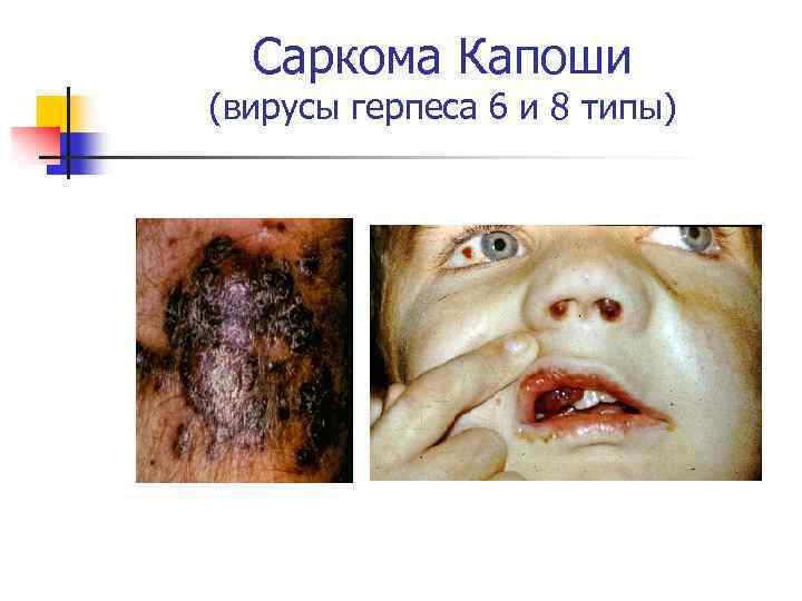 Саркома Капоши (вирусы герпеса 6 и 8 типы) 