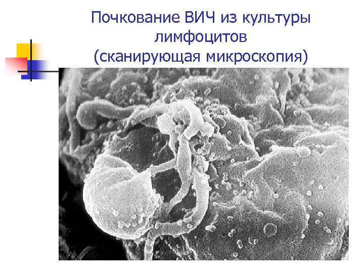 Почкование ВИЧ из культуры лимфоцитов (сканирующая микроскопия) 