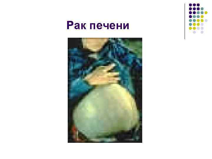 Рак печени 