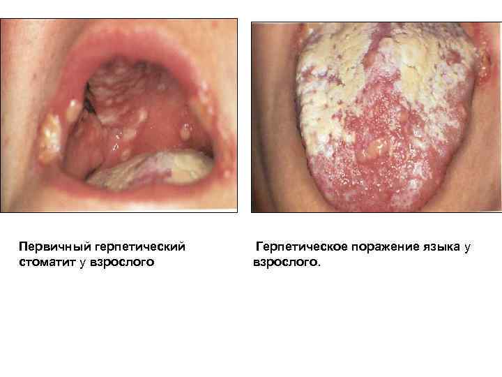 Первичный герпетический стоматит у взрослого Герпетическое поражение языка у взрослого. 