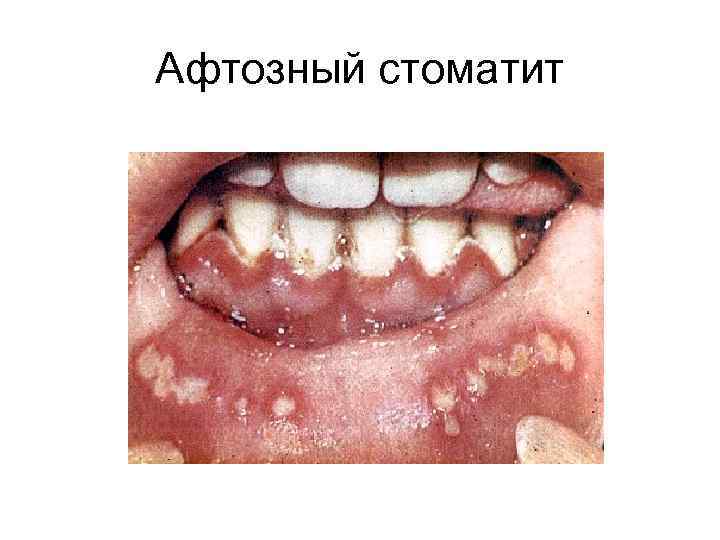 Афтозный стоматит 