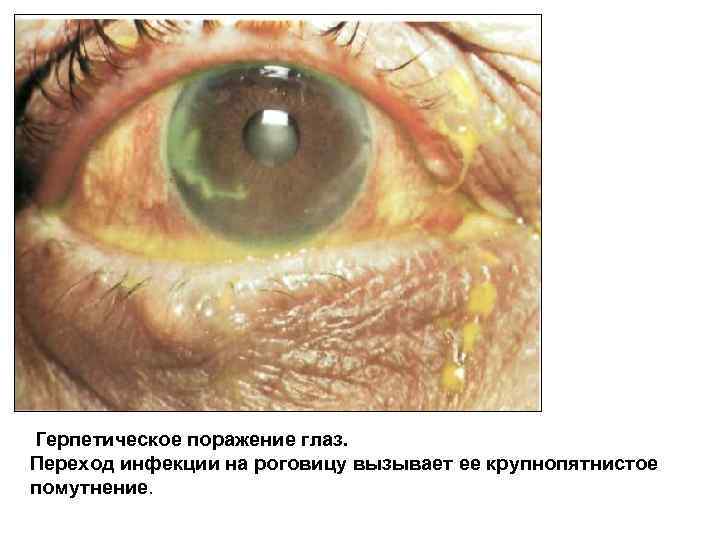 Герпетическое поражение глаз. Переход инфекции на роговицу вызывает ее крупнопятнистое помутнение. 
