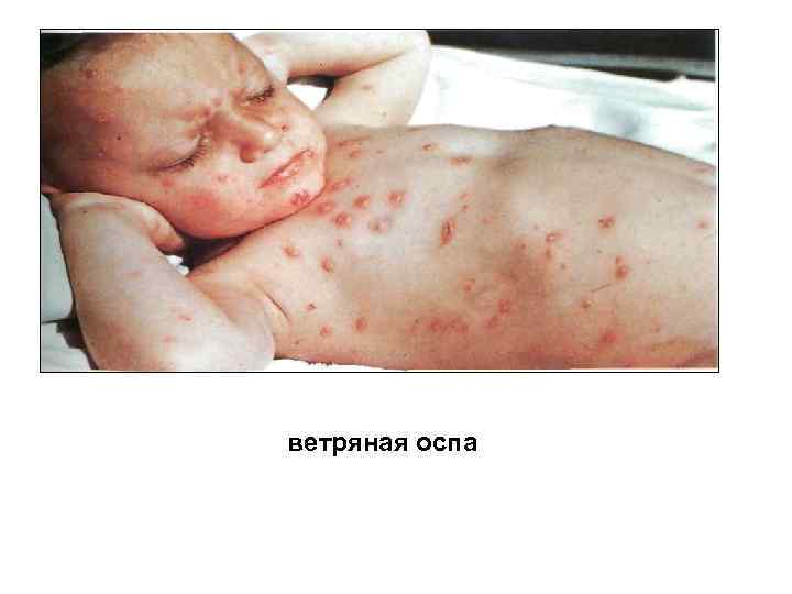 ветряная оспа 