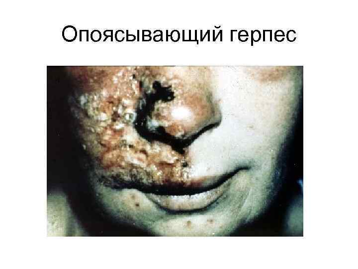 Опоясывающий герпес 