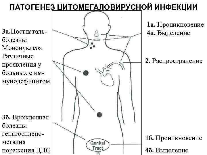 ПАТОГЕНЕЗ ЦИТОМЕГАЛОВИРУСНОЙ ИНФЕКЦИИ 3 а. Постнаталь- ная болезнь: Мононуклеоз Различные проявления у больных с