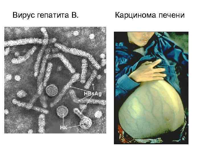 Вирус гепатита В. Карцинома печени 