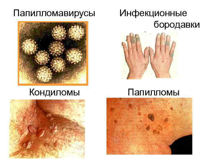 Папилломавирусы Кондиломы Инфекционные бородавки Папилломы 